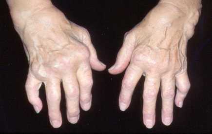 autoimuninis reumatoidinis artritas visi artropatijos