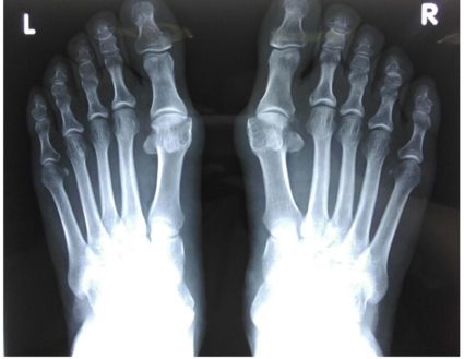 gydymas liaudies gynimo artrosis kojomis