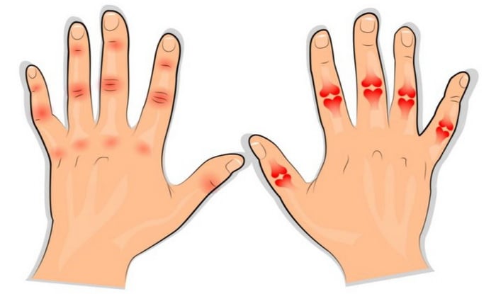 gydymas sąnarių altajaus prevencija artrito ant rankų