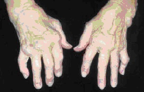 liga kodėl sąnarių sukelia skausmo peties sąnario iš kairės rankos