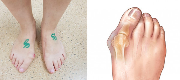 priemonė pėdos sąnarių bakterijos sukelia ligas sąnarių