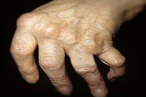 liaudies gynimo priemonės su skausmais rankų sąnariuose
